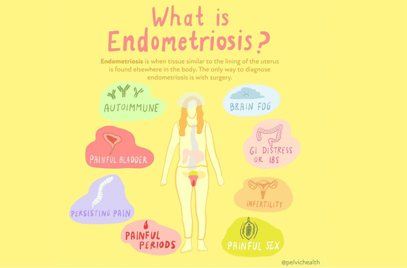 what is Endometriosis Endometriosis