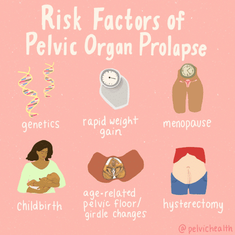 Pelvic Organ Prolapse