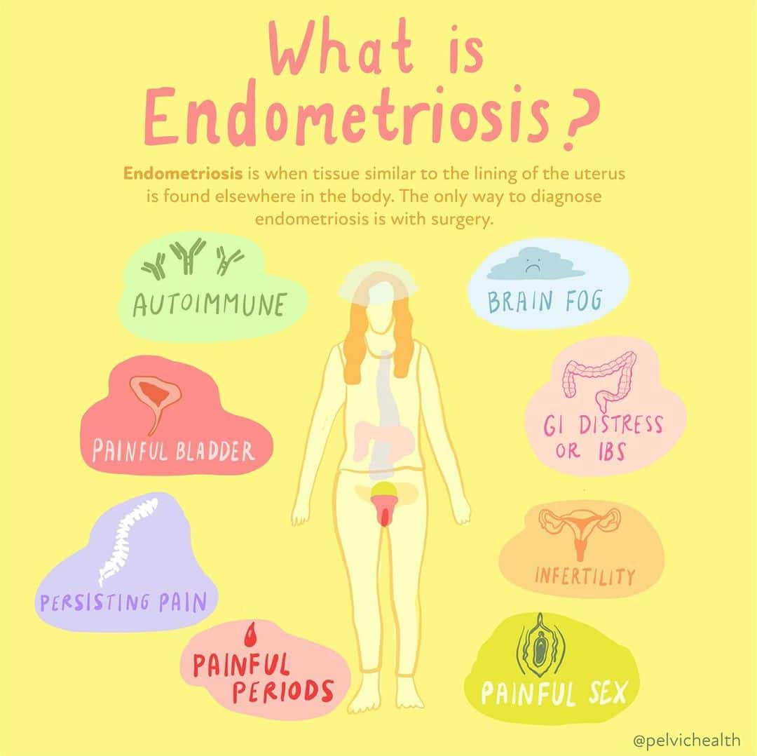 ENDO_whatisendometriosis Endometriosis